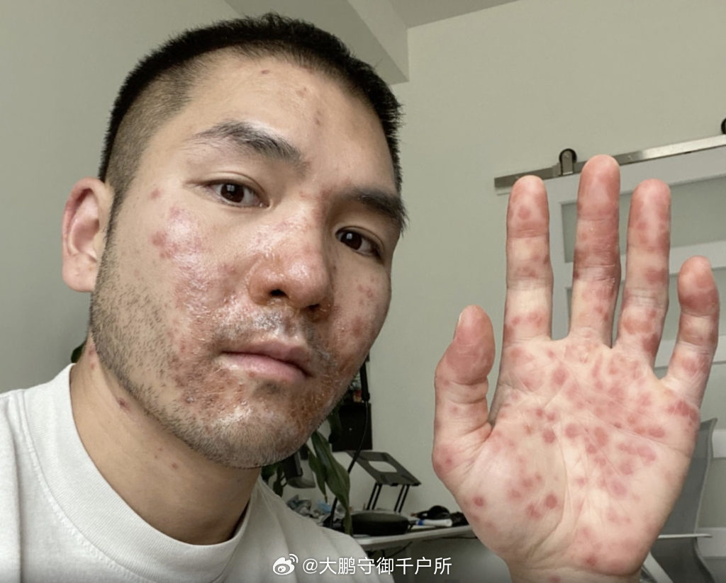 阿根廷猴痘病例达78例，猴痘与日常生活的奇妙交织，阿根廷的温馨抗疫故事
