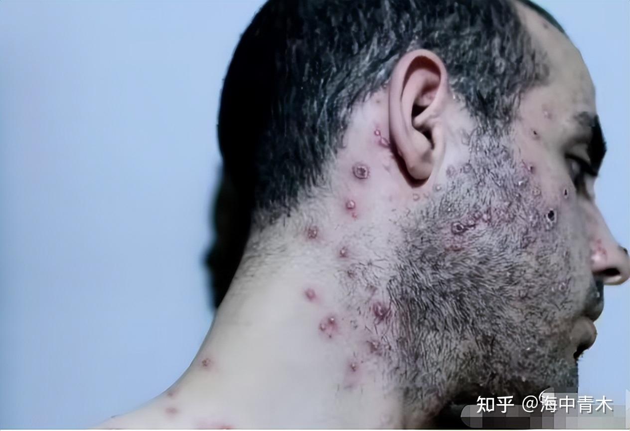 阿根廷猴痘病例动态，共同应对，展现自信与成就感的征程