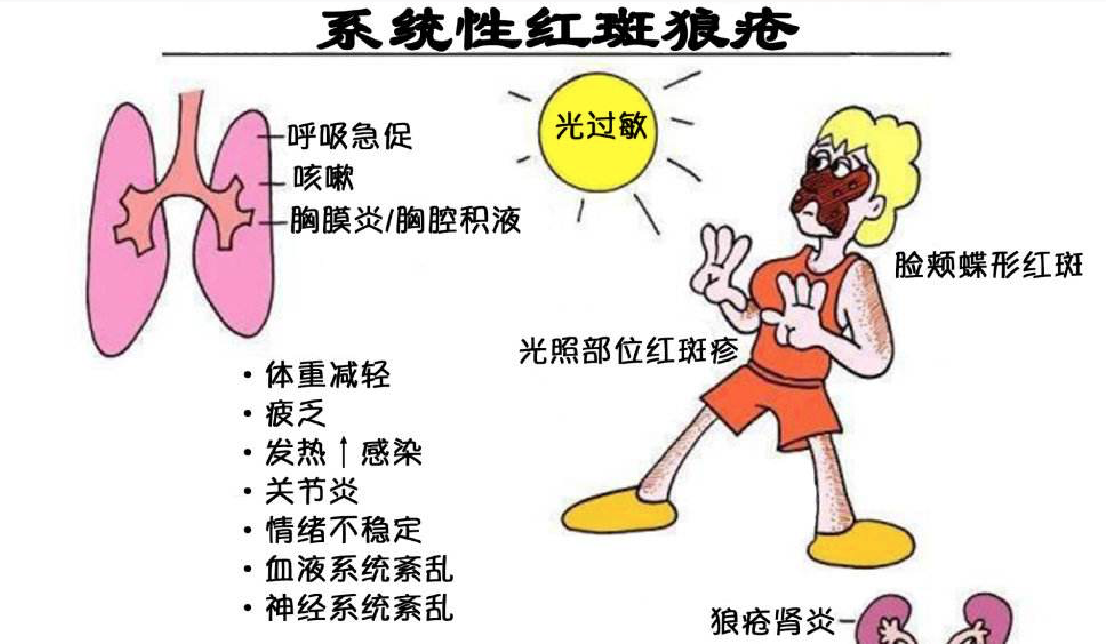 系统性红斑狼疮研究的最新进展与动态探索